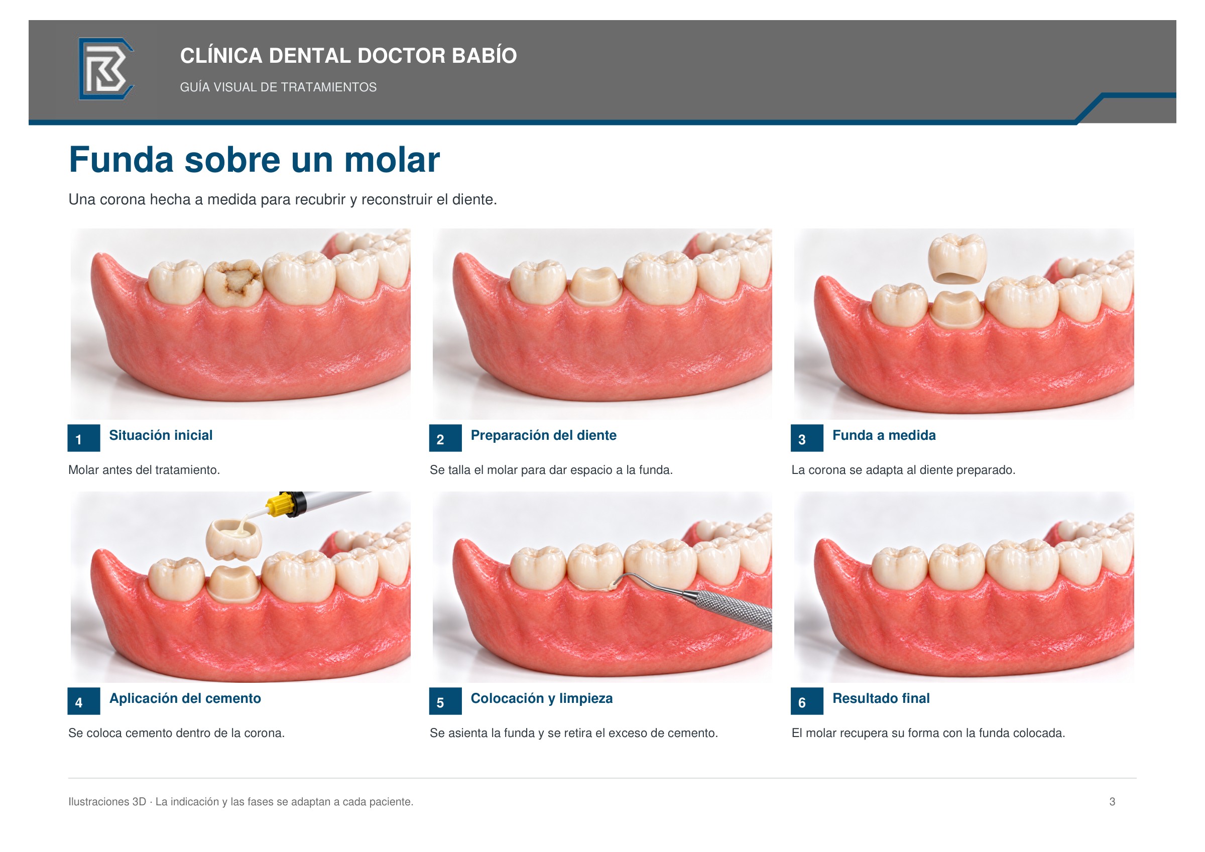 Funda sobre un molar: secuencia ilustrada, página 3 del cuaderno
