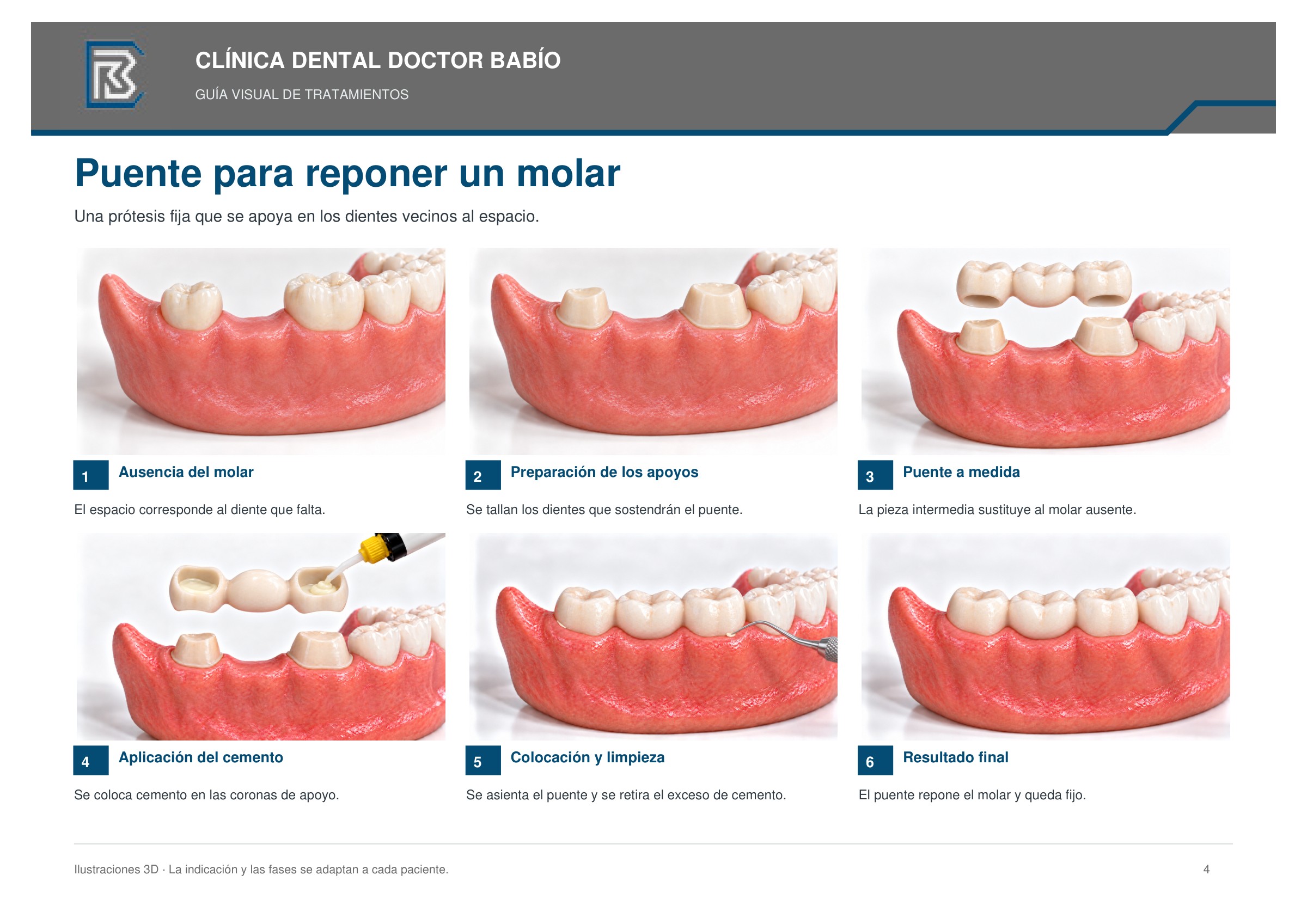 Puente para reponer un molar: secuencia ilustrada, página 4 del cuaderno
