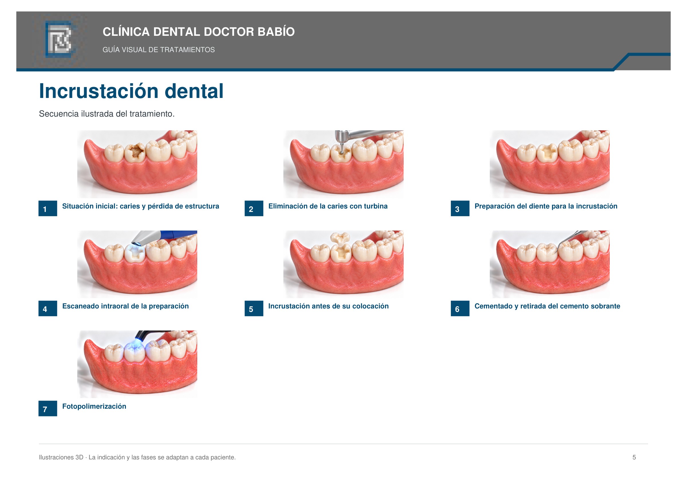 Incrustación dental: secuencia ilustrada, página 5 del cuaderno