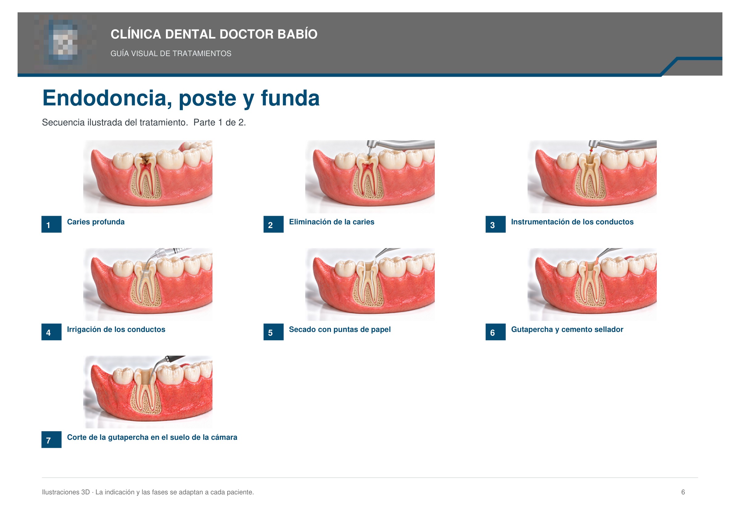 Endodoncia, poste y funda: secuencia ilustrada, página 6 del cuaderno