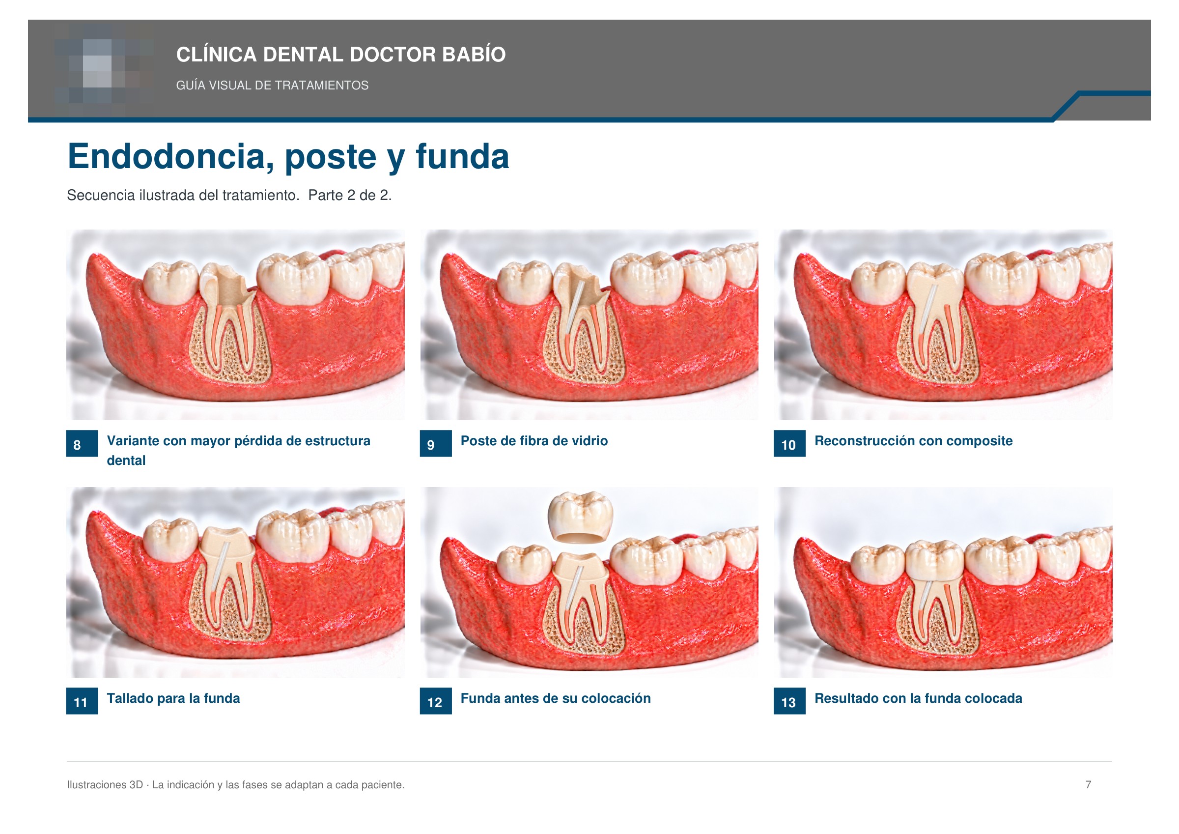 Endodoncia, poste y funda: secuencia ilustrada, página 7 del cuaderno