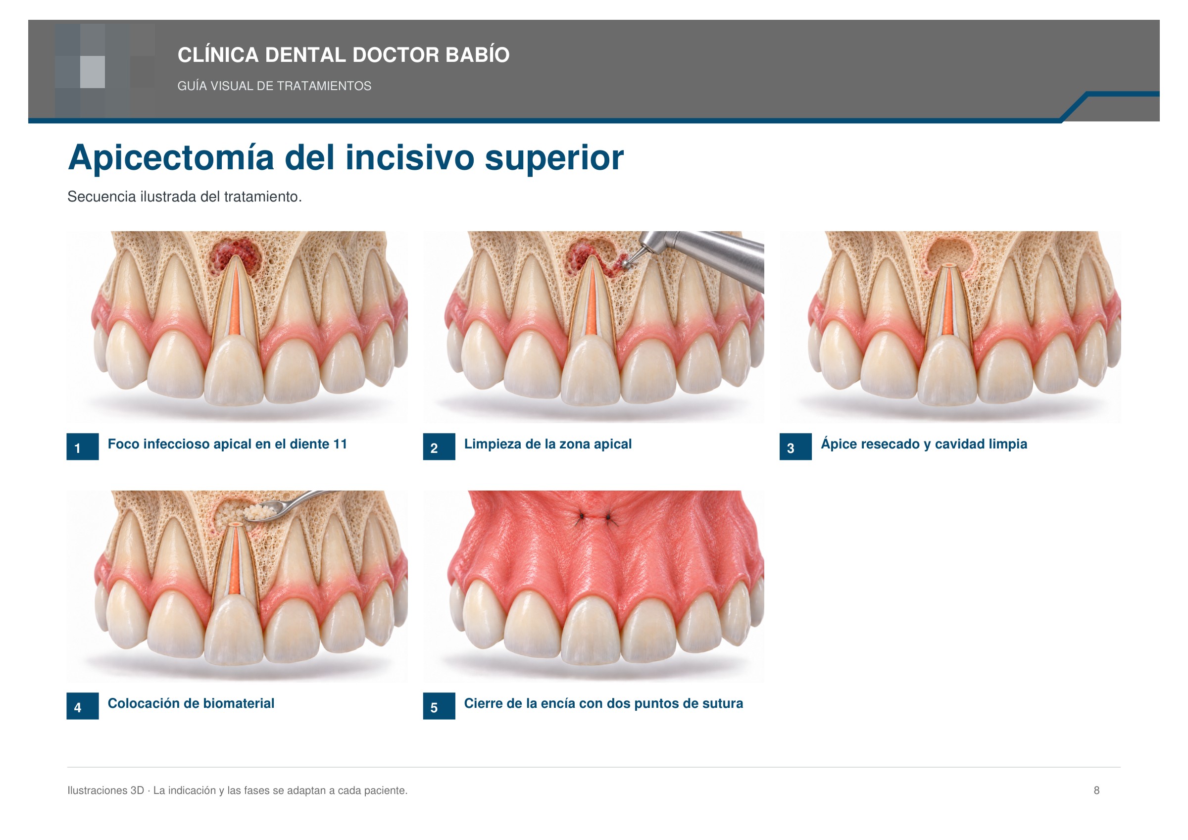 Apicectomía del incisivo superior: secuencia ilustrada, página 8 del cuaderno