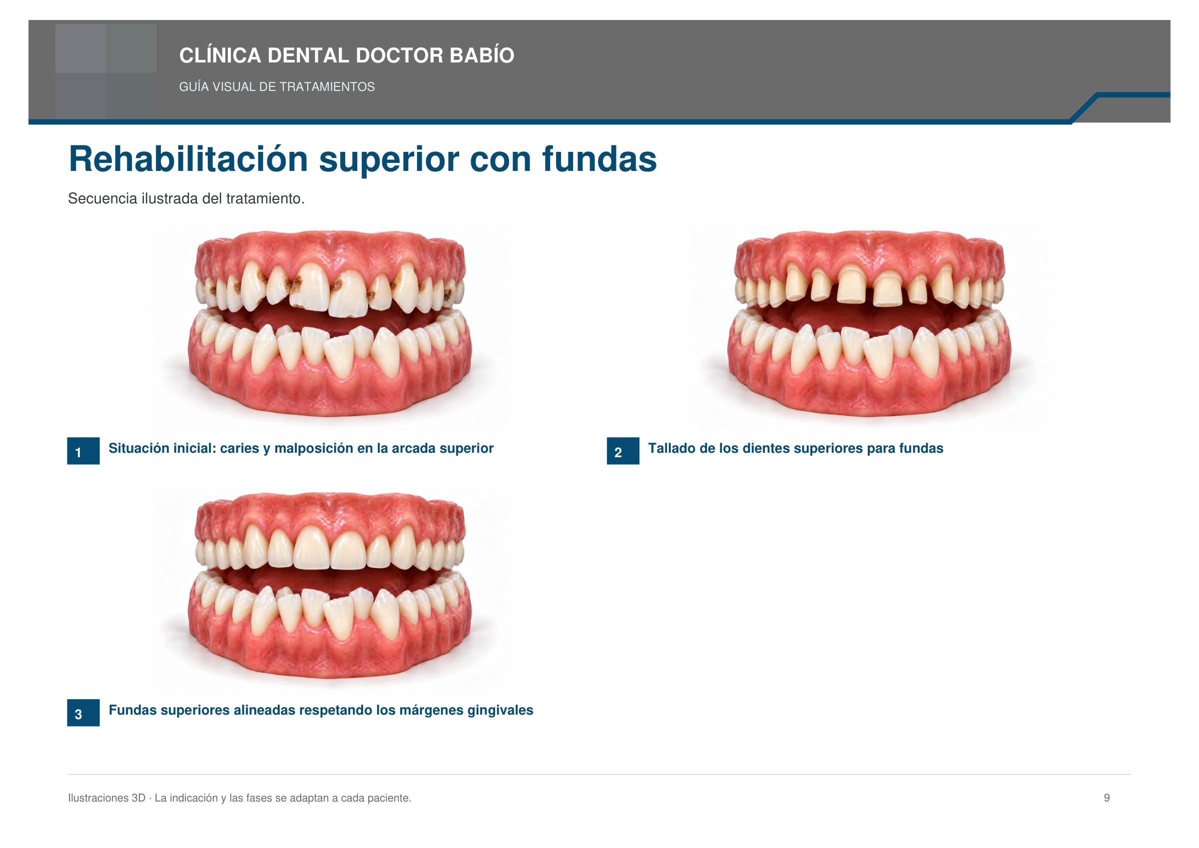 Rehabilitación superior con fundas: secuencia ilustrada, página 9 del cuaderno