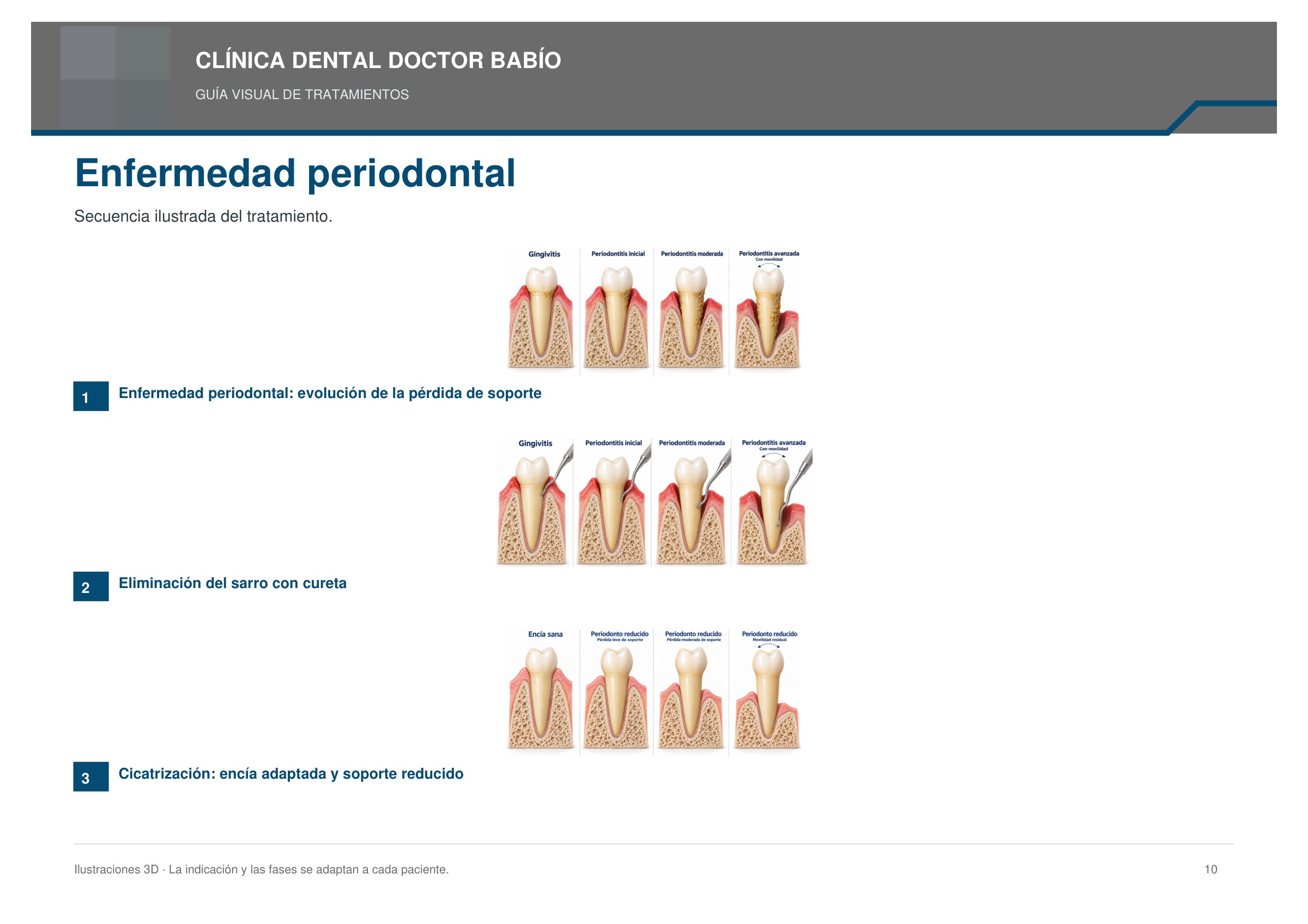 Enfermedad periodontal: secuencia ilustrada, página 10 del cuaderno