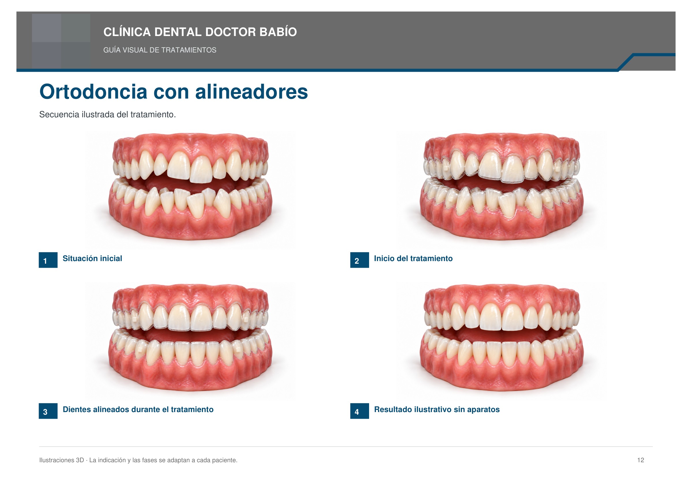 Ortodoncia con alineadores: secuencia ilustrada, página 12 del cuaderno