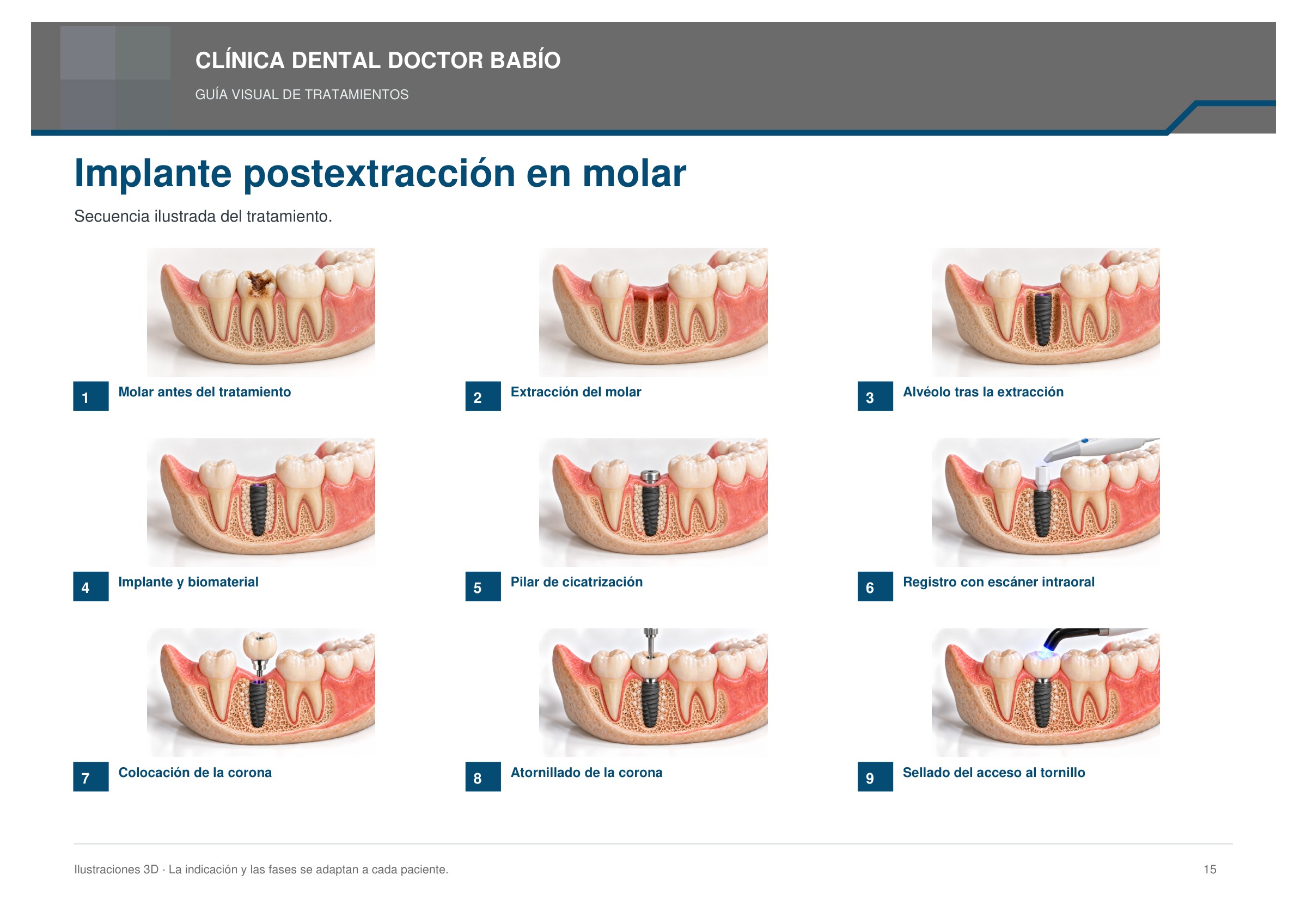 Implante postextracción en molar: secuencia ilustrada, página 15 del cuaderno