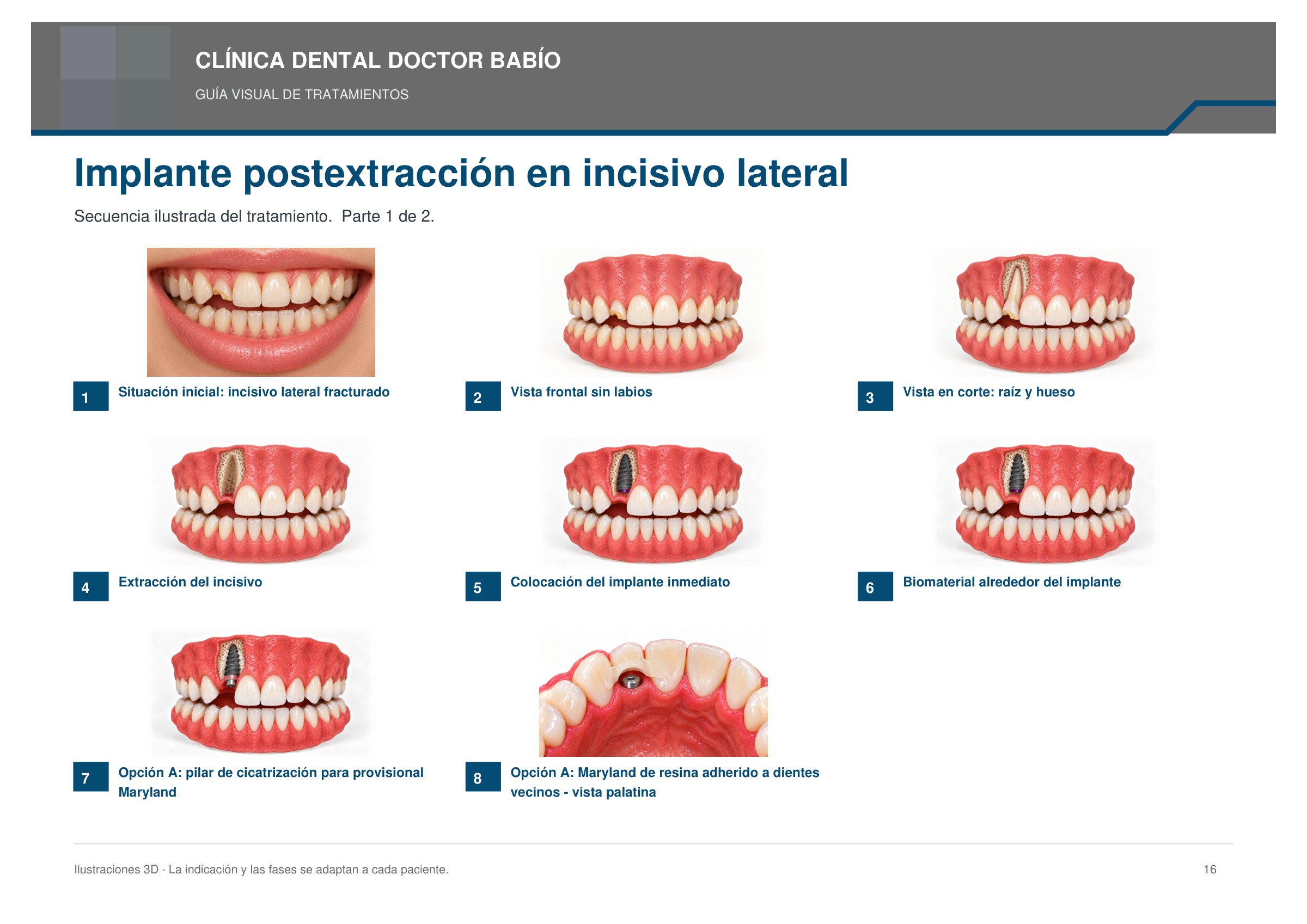 Implante postextracción en incisivo lateral: secuencia ilustrada, página 16 del cuaderno