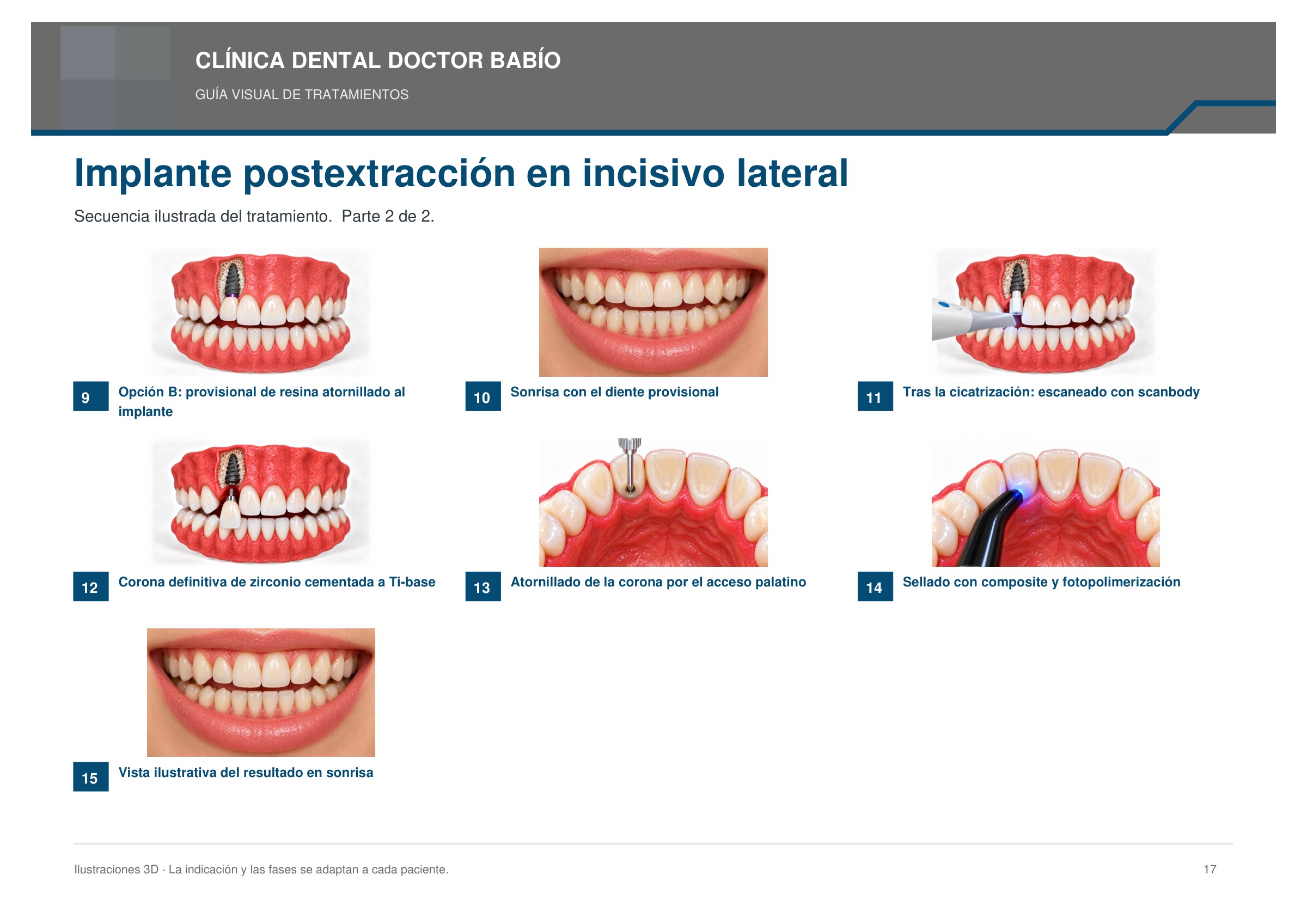 Implante postextracción en incisivo lateral: secuencia ilustrada, página 17 del cuaderno