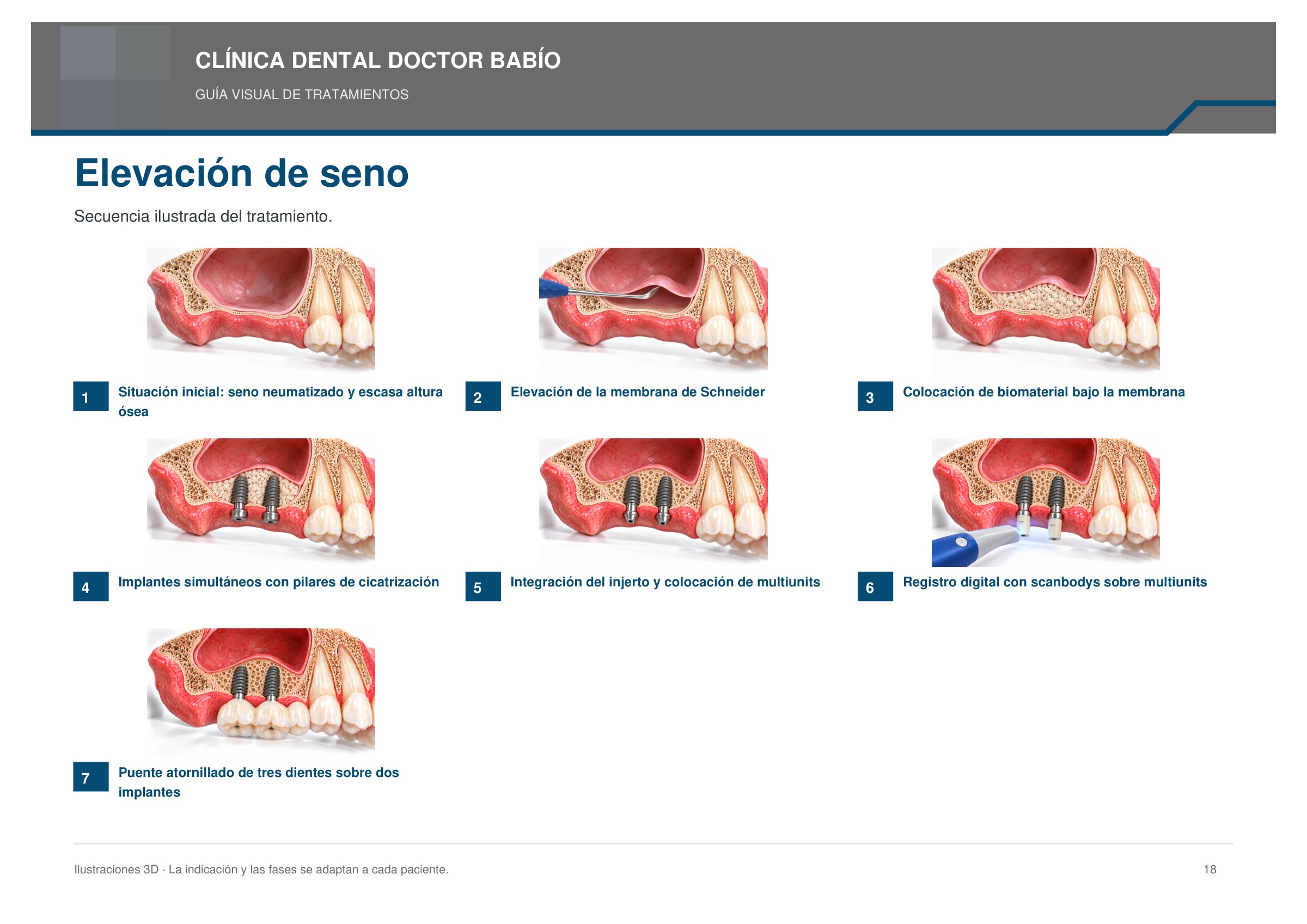 Elevación de seno: secuencia ilustrada, página 18 del cuaderno