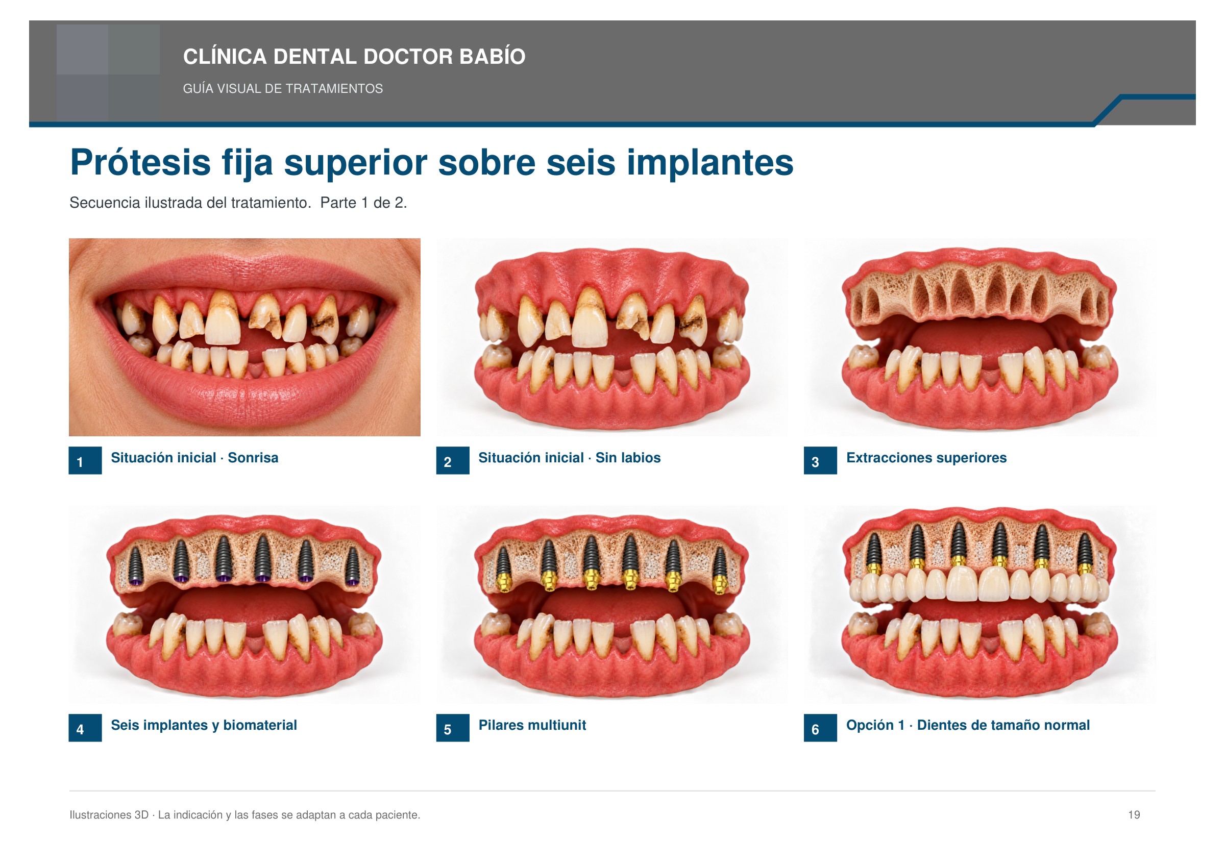 Prótesis fija superior sobre seis implantes: secuencia ilustrada, página 19 del cuaderno