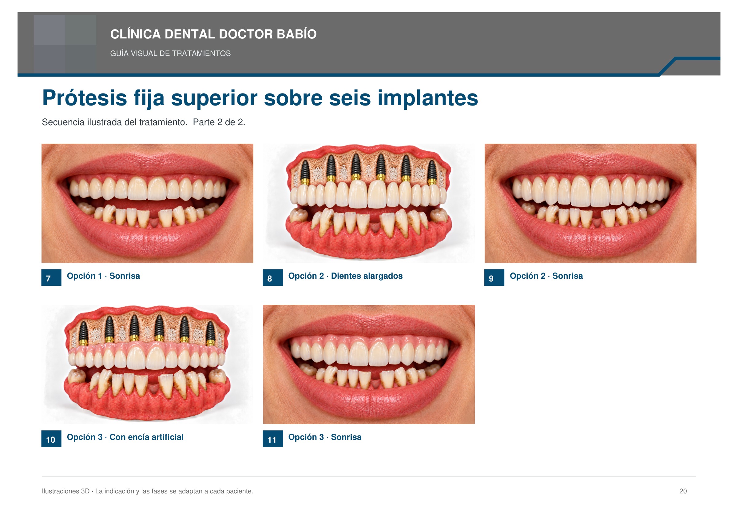 Prótesis fija superior sobre seis implantes: secuencia ilustrada, página 20 del cuaderno