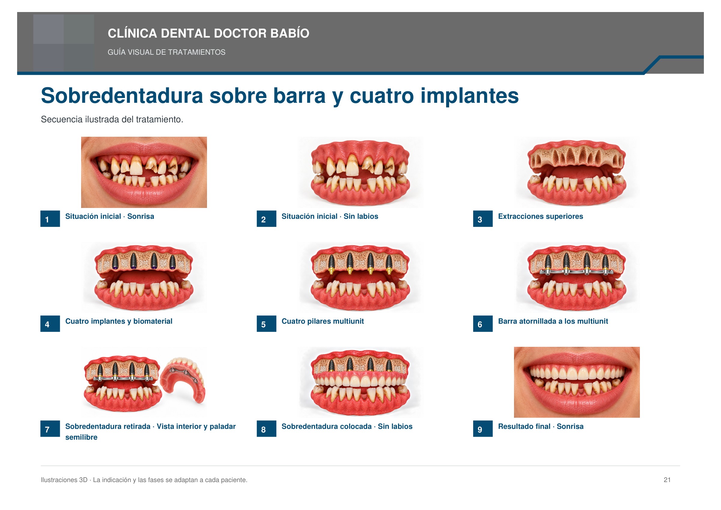 Sobredentadura sobre barra y cuatro implantes: secuencia ilustrada, página 21 del cuaderno