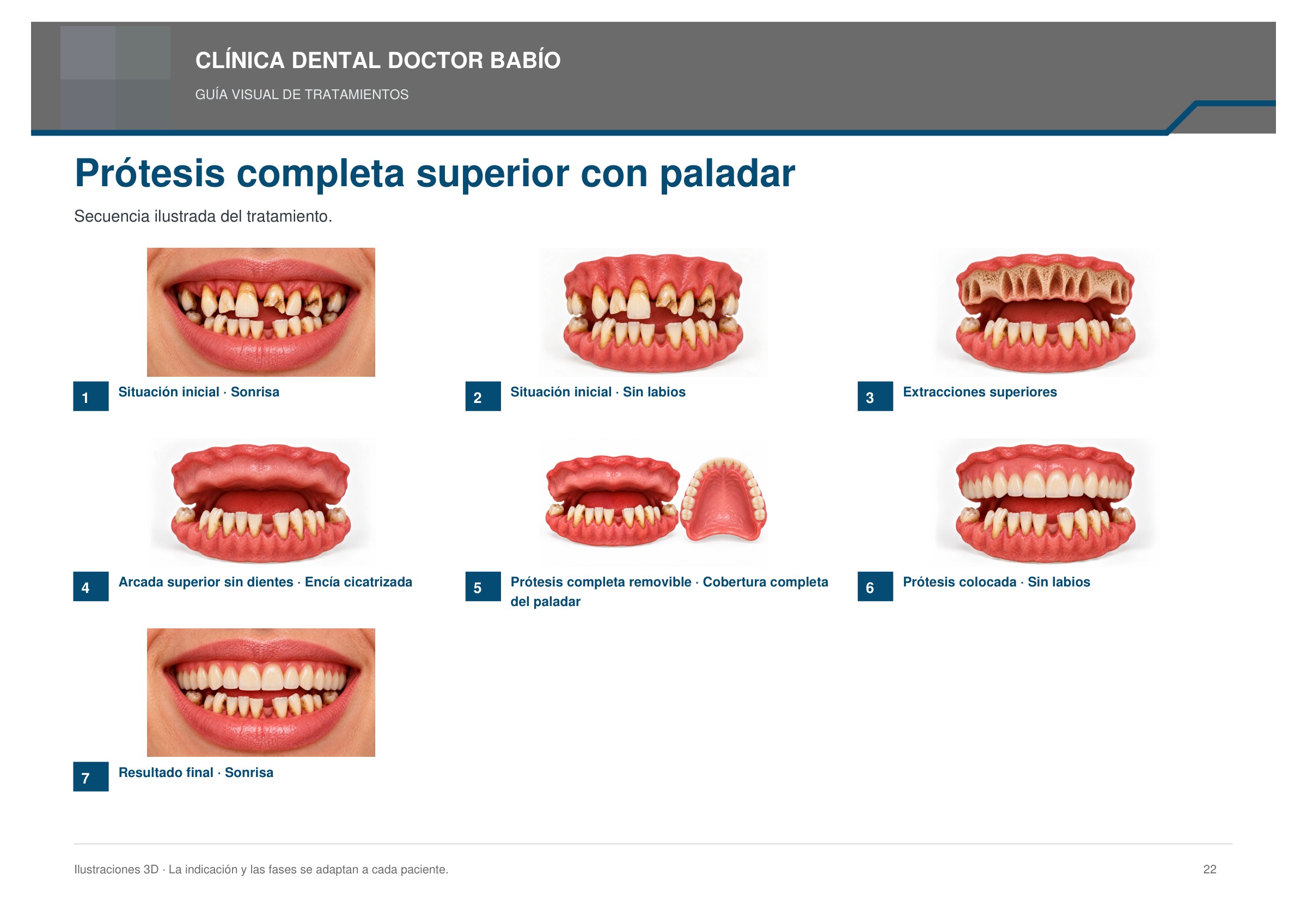 Prótesis completa superior con paladar: secuencia ilustrada, página 22 del cuaderno