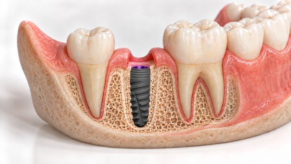 Ilustración 3D: Implante unitario