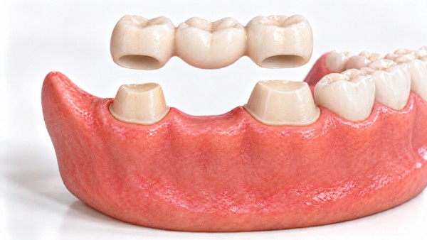 Ilustración 3D: Puente para reponer un molar