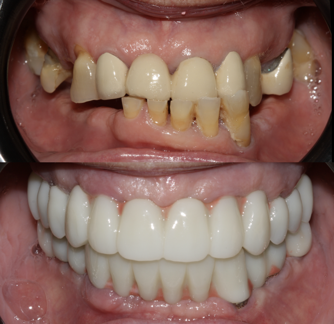 Antes y después intraoral en un caso de implantología y carga inmediata