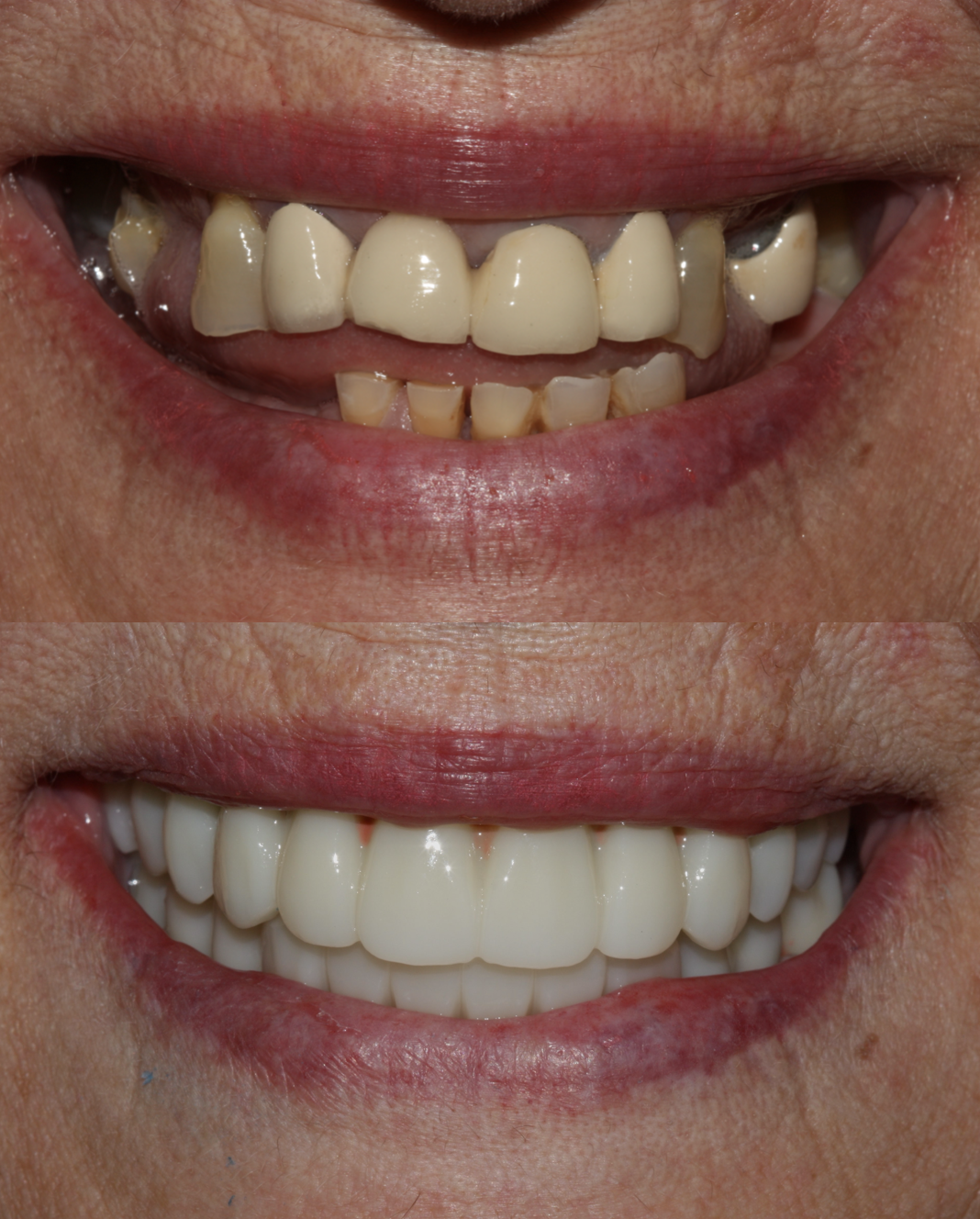 Antes y después de sonrisa en un tratamiento de implantología y carga inmediata