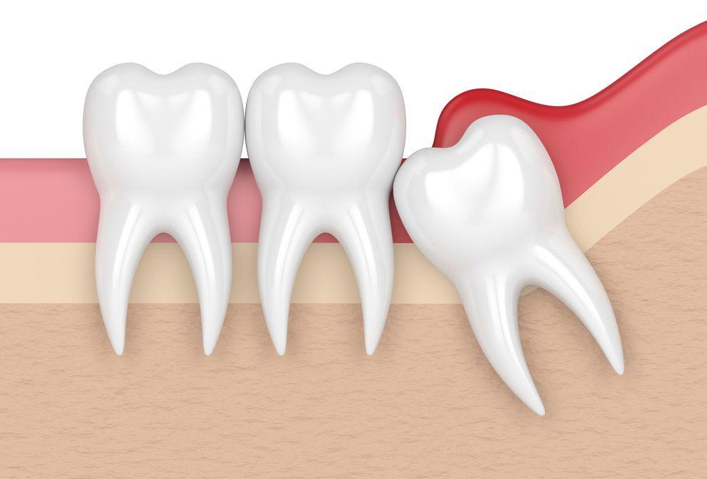Ilustración de una extracción en cirugía oral