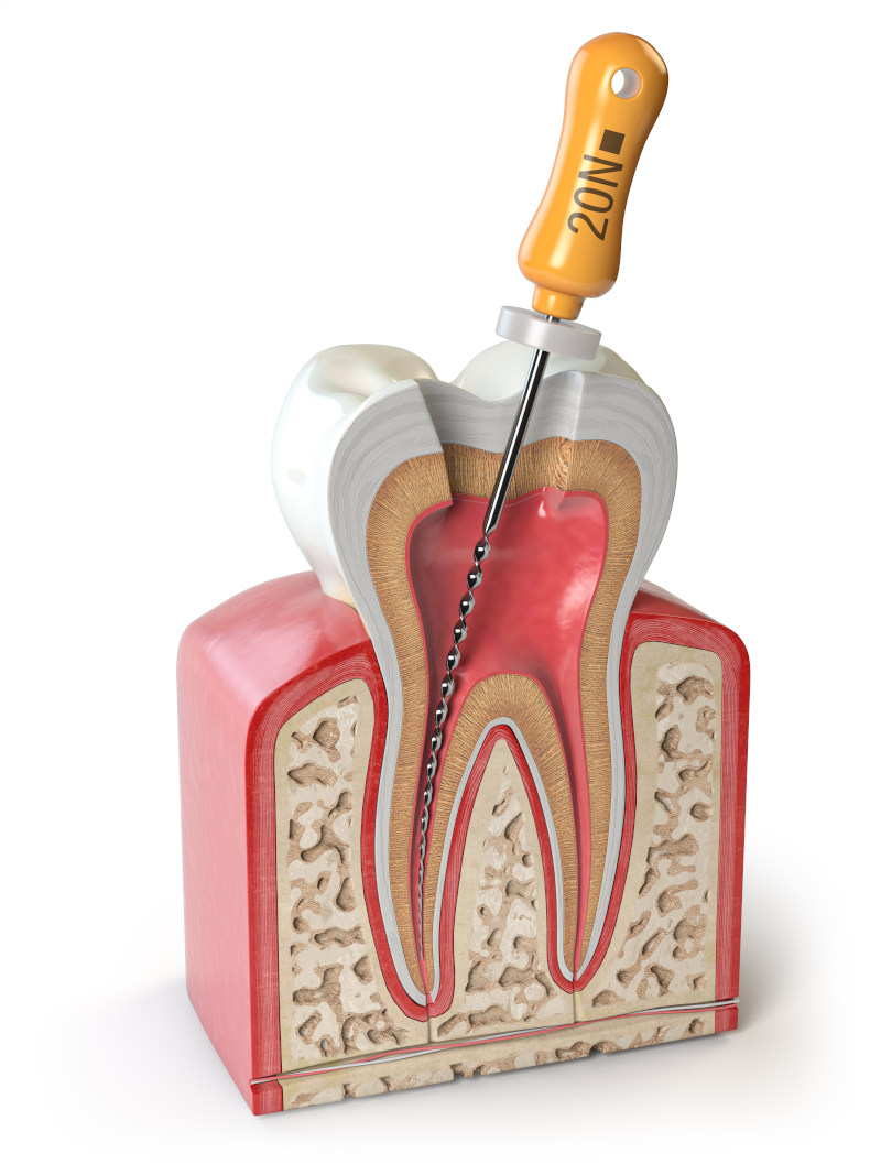 Ilustración de endodoncia con diente, encía y raíces