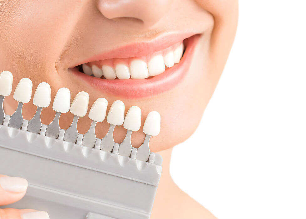Imagen de estética dental con guía de color y sonrisa
