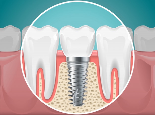 Ilustración de un implante dental
