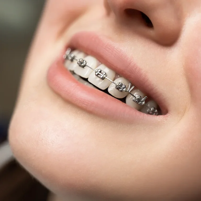 Imagen de ortodoncia con brackets