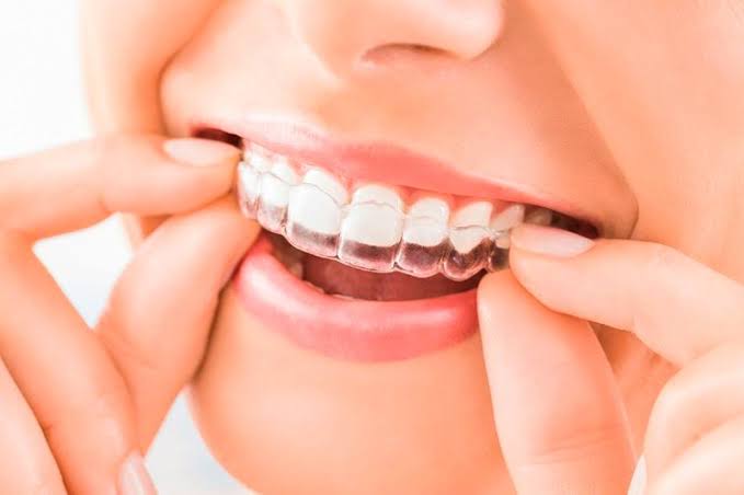 Imagen de ortodoncia invisible con alineadores transparentes