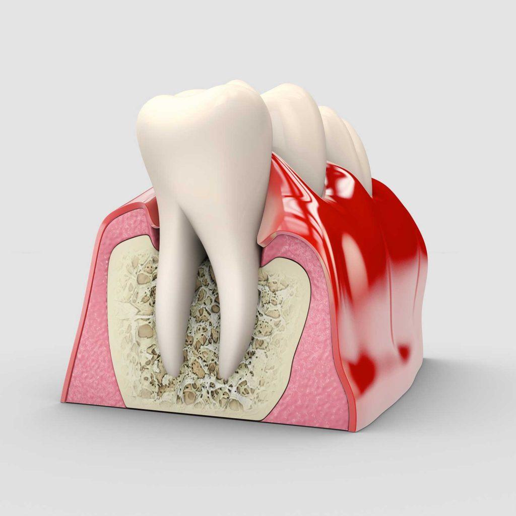 Ilustración de periodoncia con diente, encía y hueso de soporte