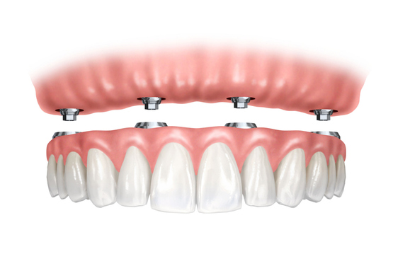 Ilustración de una prótesis dental sobre implantes