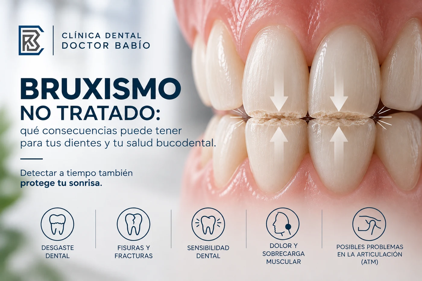 Bruxismo con desgaste dental por contacto entre incisivos superiores e inferiores