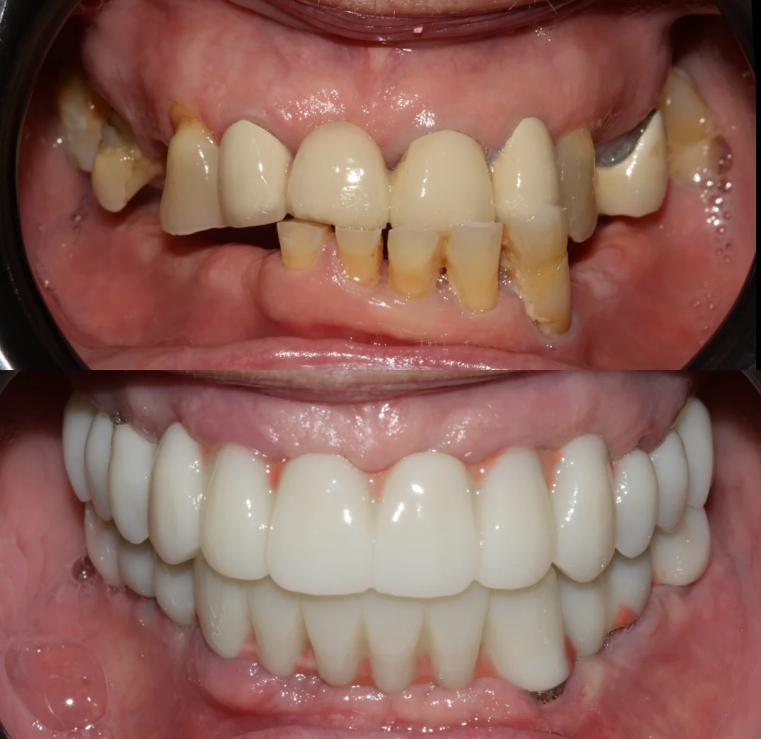 Antes y después intraoral en un caso de implantología y carga inmediata