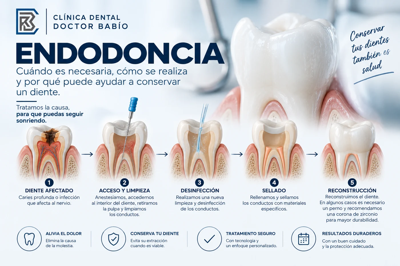 Endodoncia paso a paso: limpieza, desinfección, sellado y reconstrucción del diente