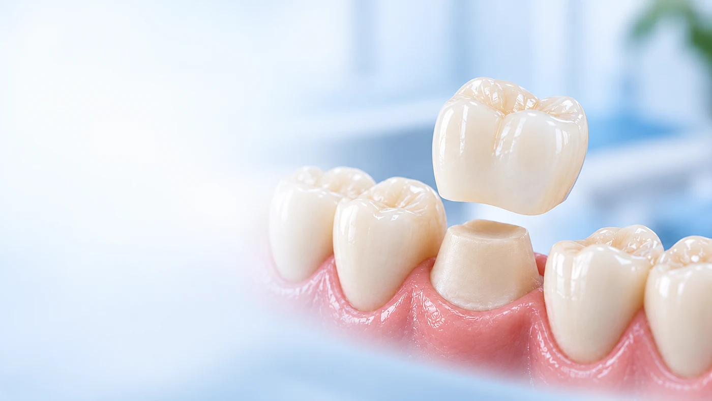 Ilustración de una corona de zirconio sobre un molar preparado
