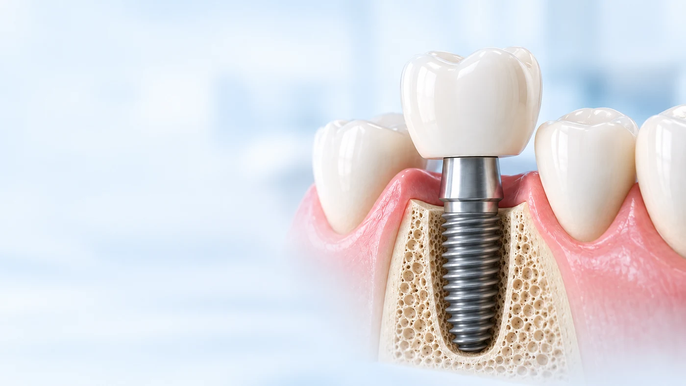 Ilustración en sección de una corona y su implante dental
