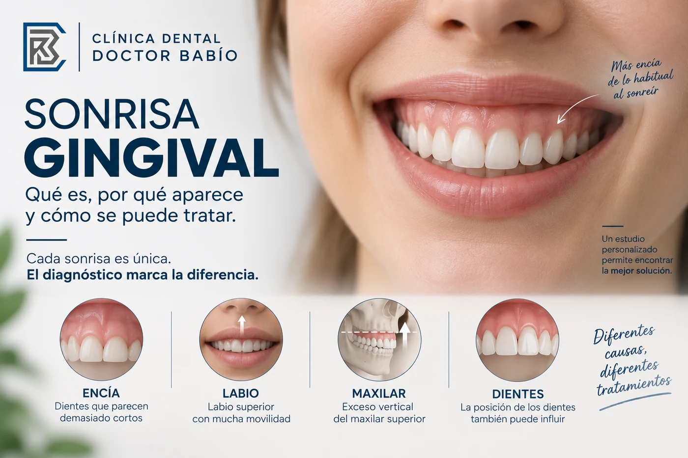 Sonrisa gingival con exposición de encía y principales causas