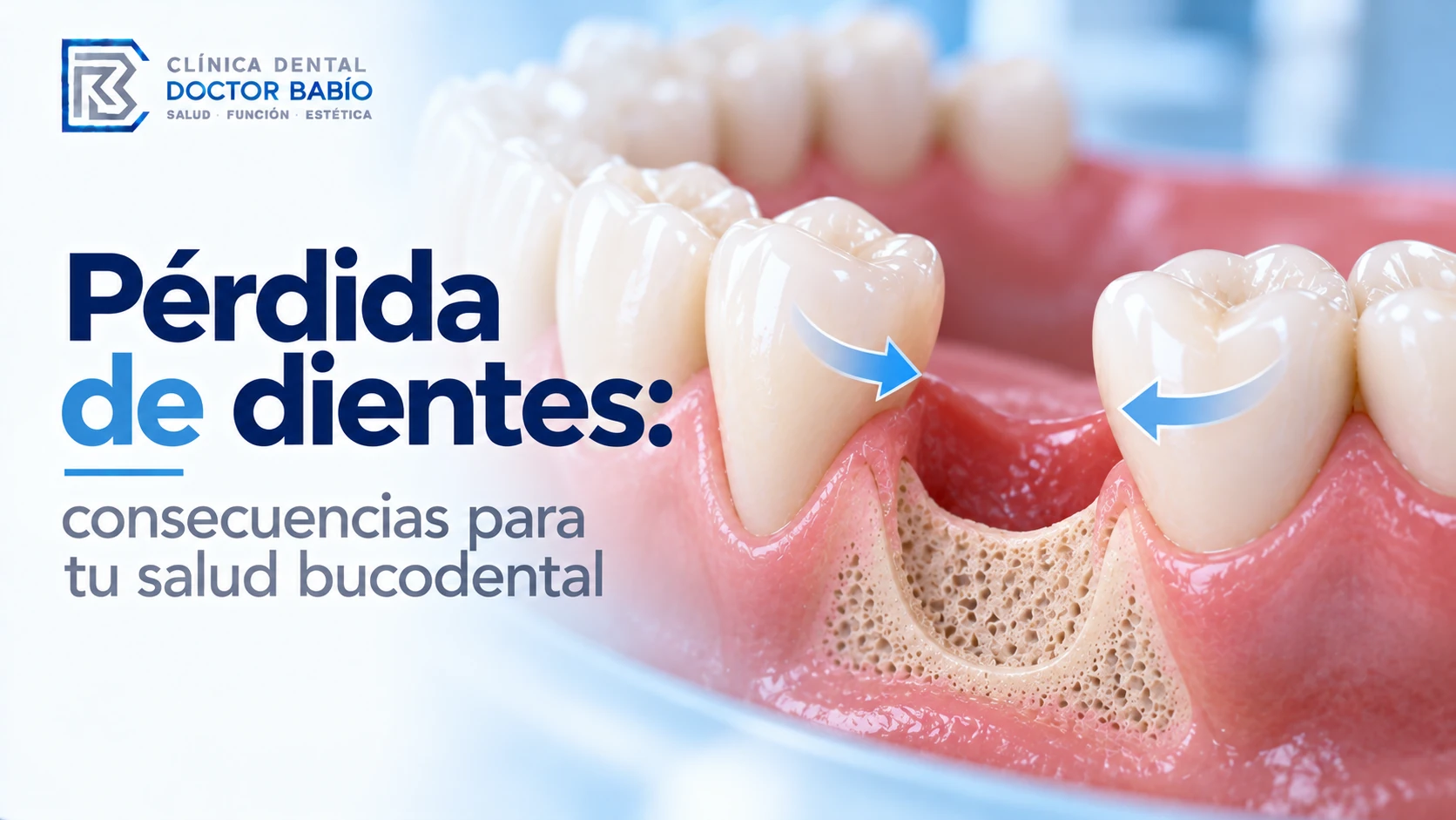 Ilustración de una muela ausente y los posibles cambios en el hueso y los dientes vecinos tras la pérdida dental.
