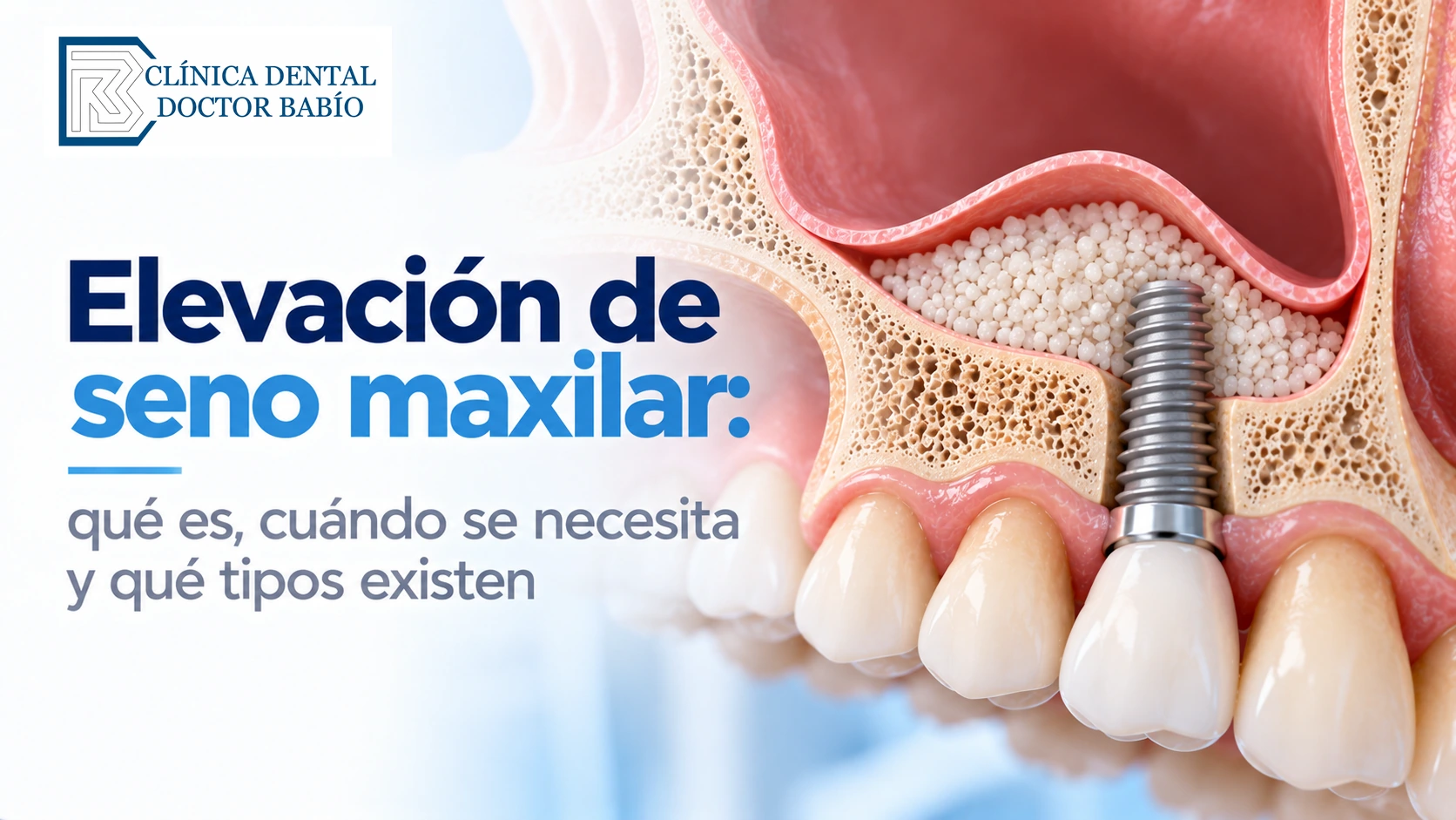 Ilustración anatómica de una elevación de seno maxilar con injerto óseo y colocación de implante dental.