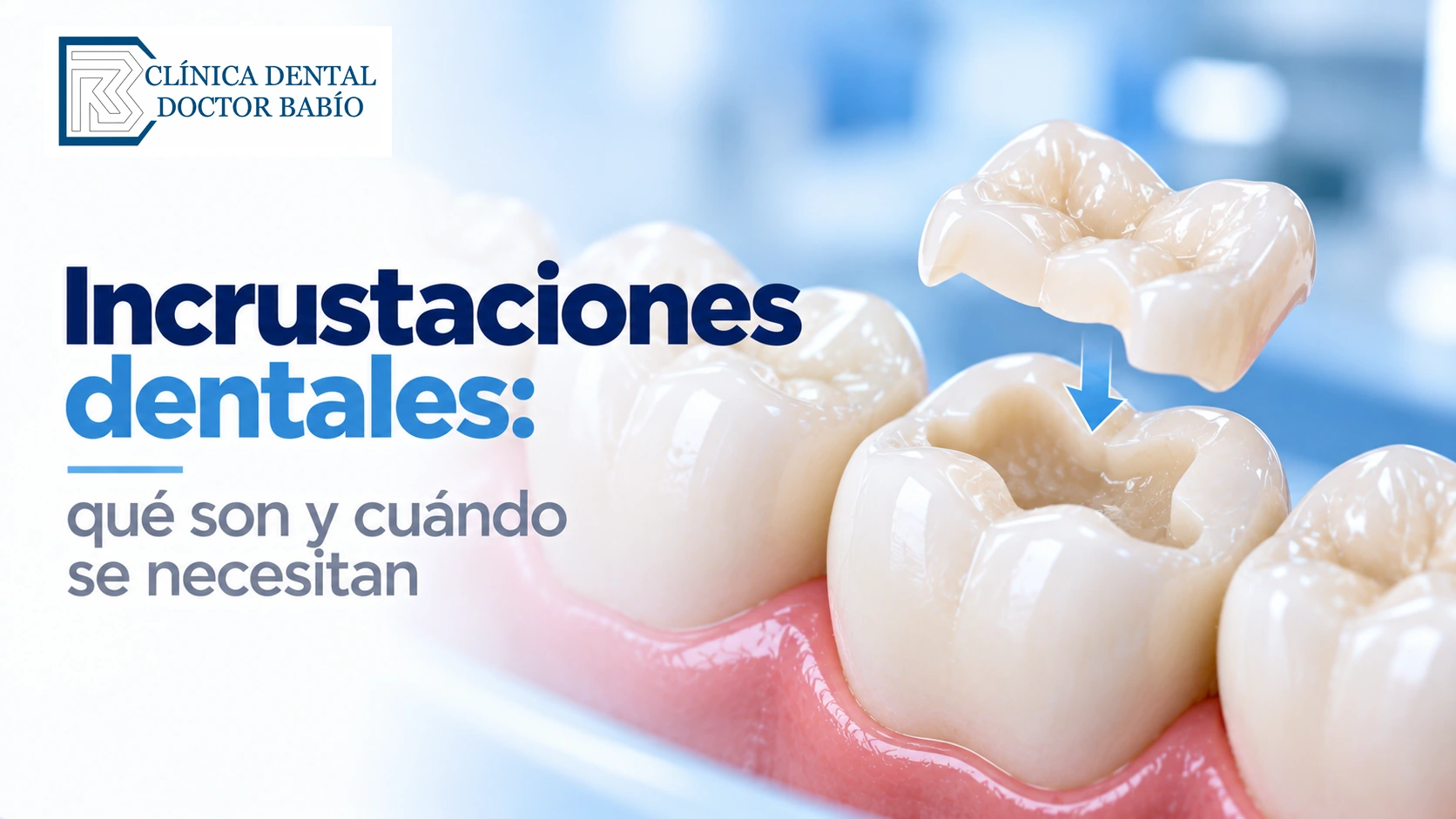 Ilustración de una incrustación dental de cerámica colocándose sobre una muela preparada.