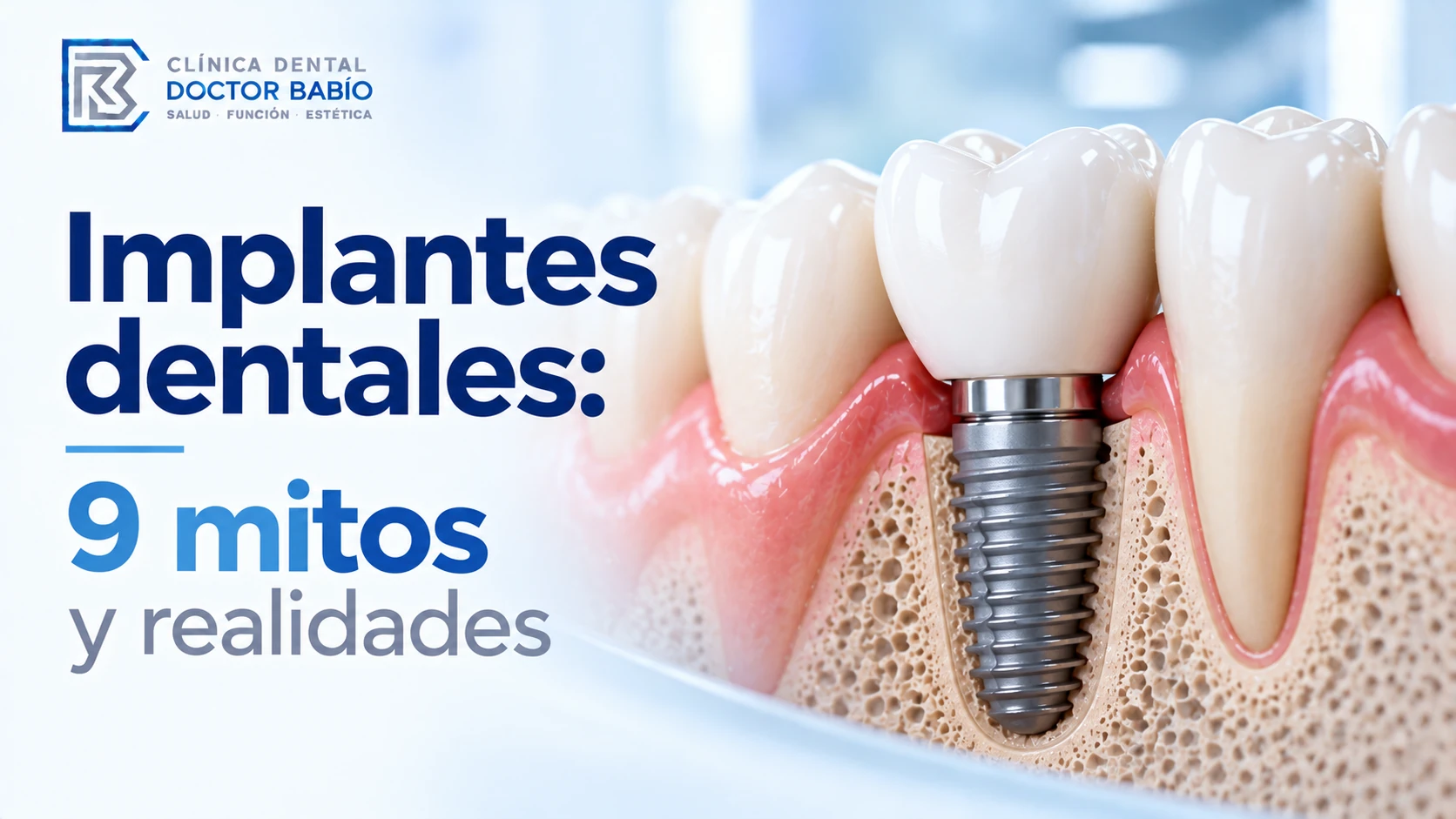 Ilustración anatómica de un implante dental junto al título 9 mitos y realidades sobre implantes dentales.
